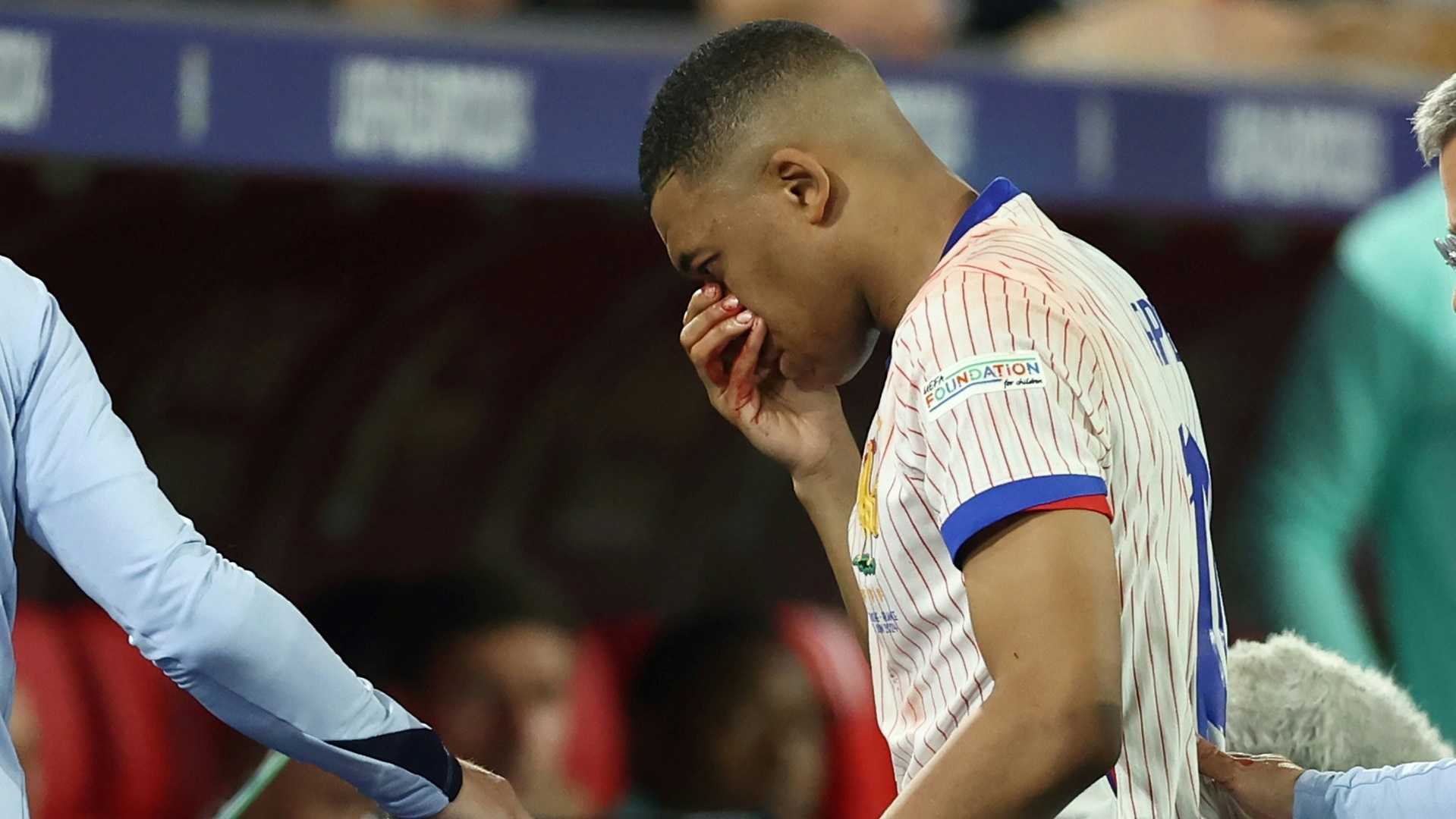 Mit blutender Nase verließ Kylian Mbappe den Platz